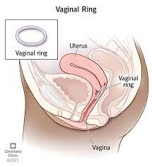 NUVARING VAGINAL RING